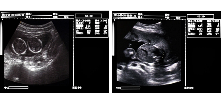 Ce Approved Hospital Equipment Sonar Baby Monitor Portable Ultrasound (YJ-U318)